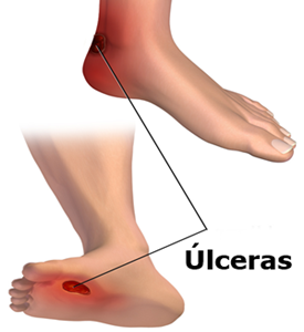 Úlceras y llagas en el pie de personas diabéticas